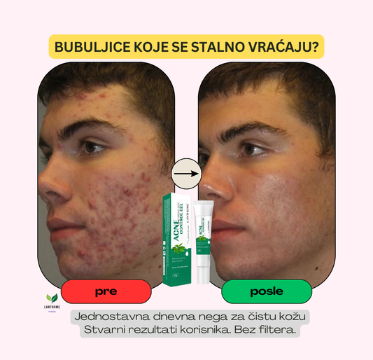 Lanthome™ Acne Gel protiv bubuljica